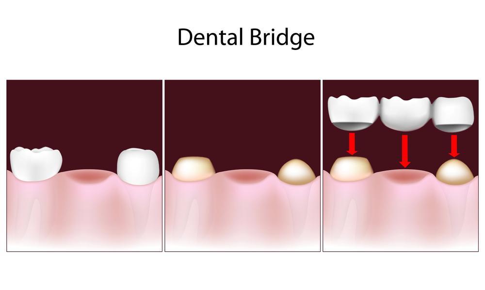 dental crowns and bridges | restorations | columbia il dentist